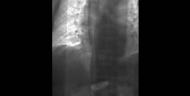 Segmento de guía metálica retirado mediante catéter lazo.