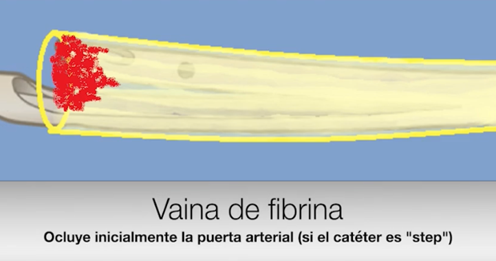 Tratamiento con balón de alta presión.